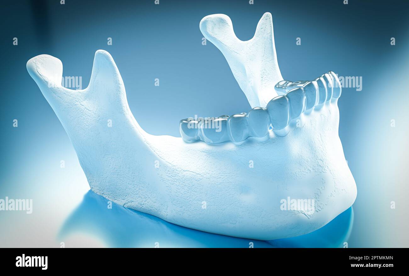 Transparent aligner orthodontic device on the teeth cast. 3d