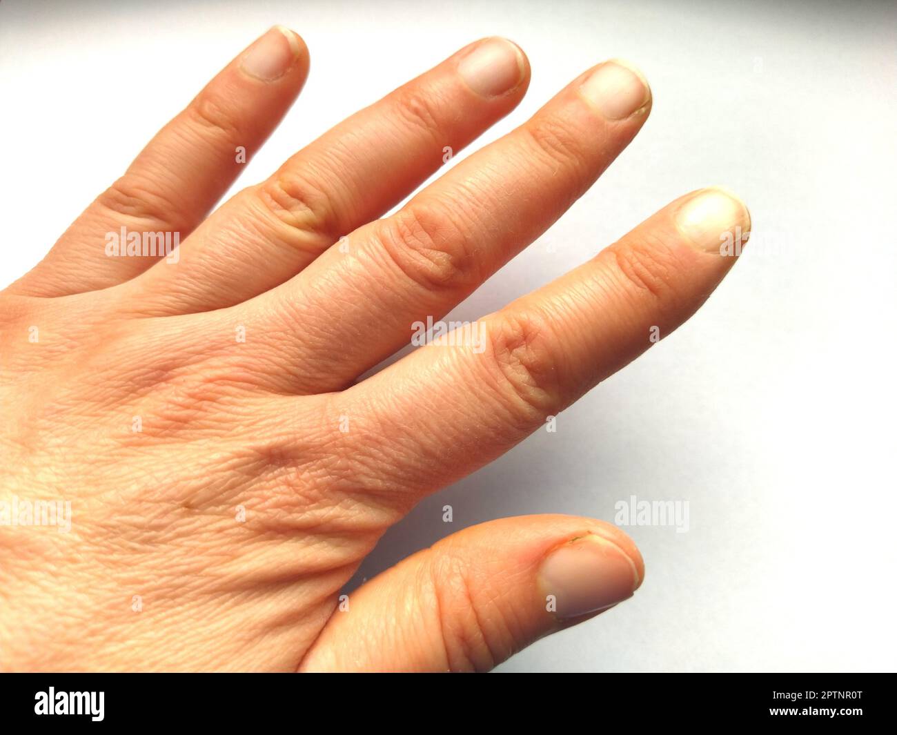 Female hand with dry atopic skin. White background. Closeup of the