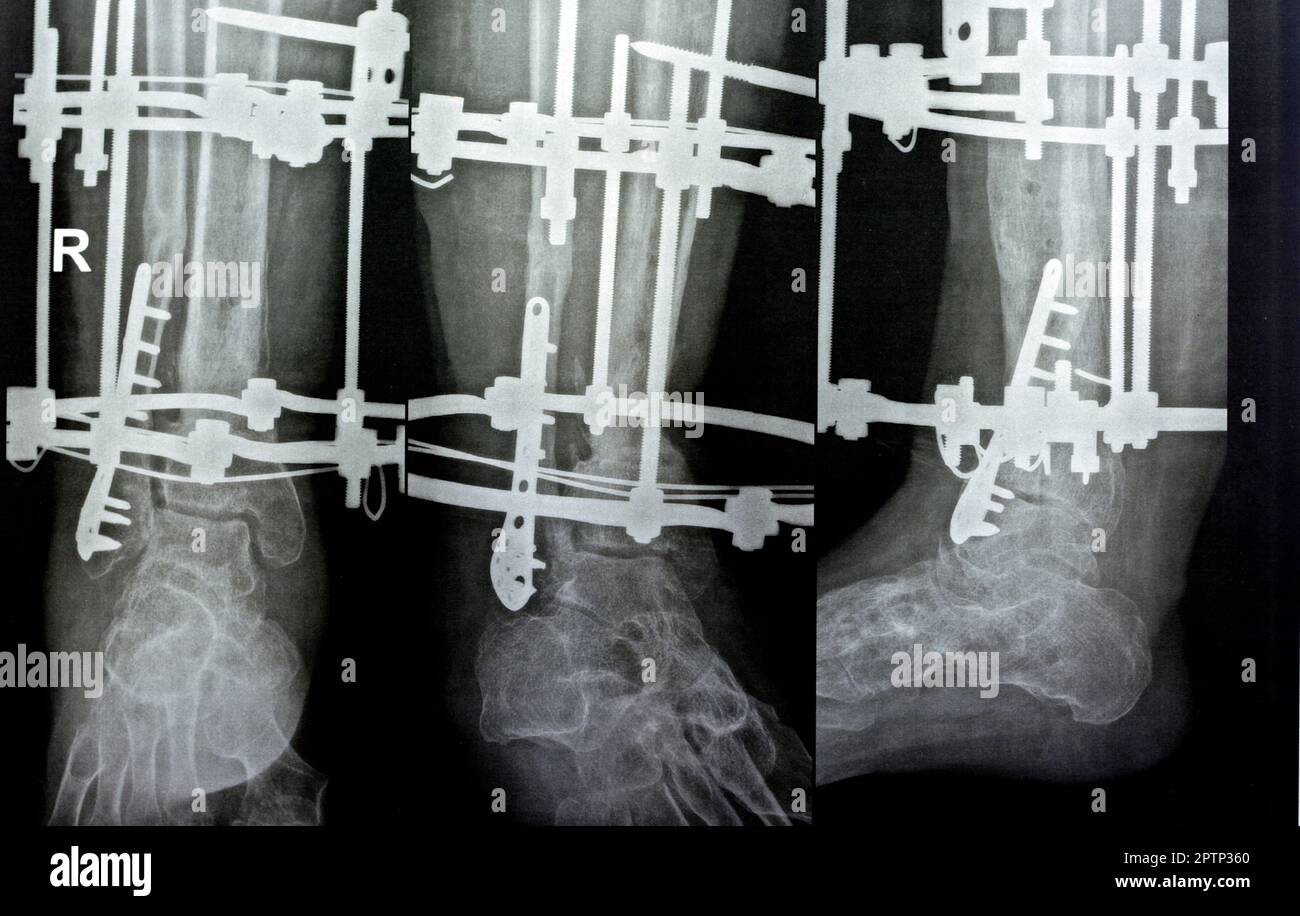 Distal comminuted fracture fibula managed by plate and screws, distal tibia managed by external ring fixator ILIZAROV frame with sclertoic bone resect Stock Photo