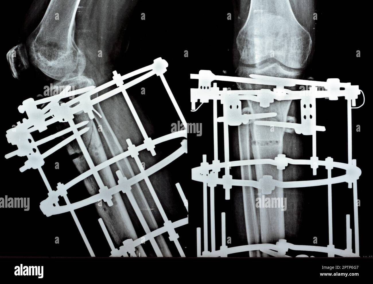 Tibia metal plate hi-res stock photography and images - Alamy