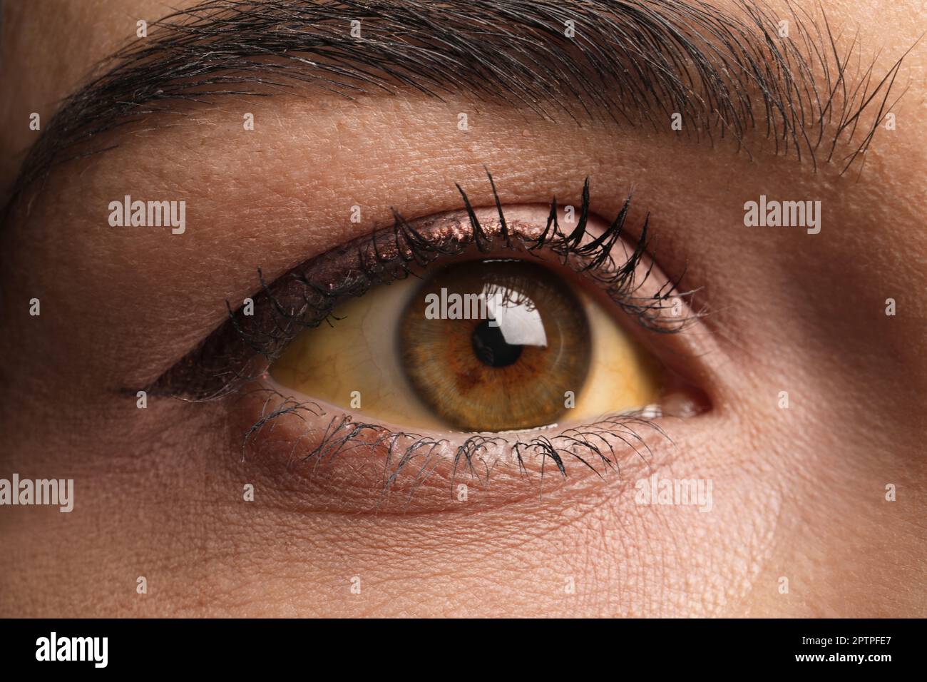 Woman with yellow eyes as background, closeup. Liver problems symptom