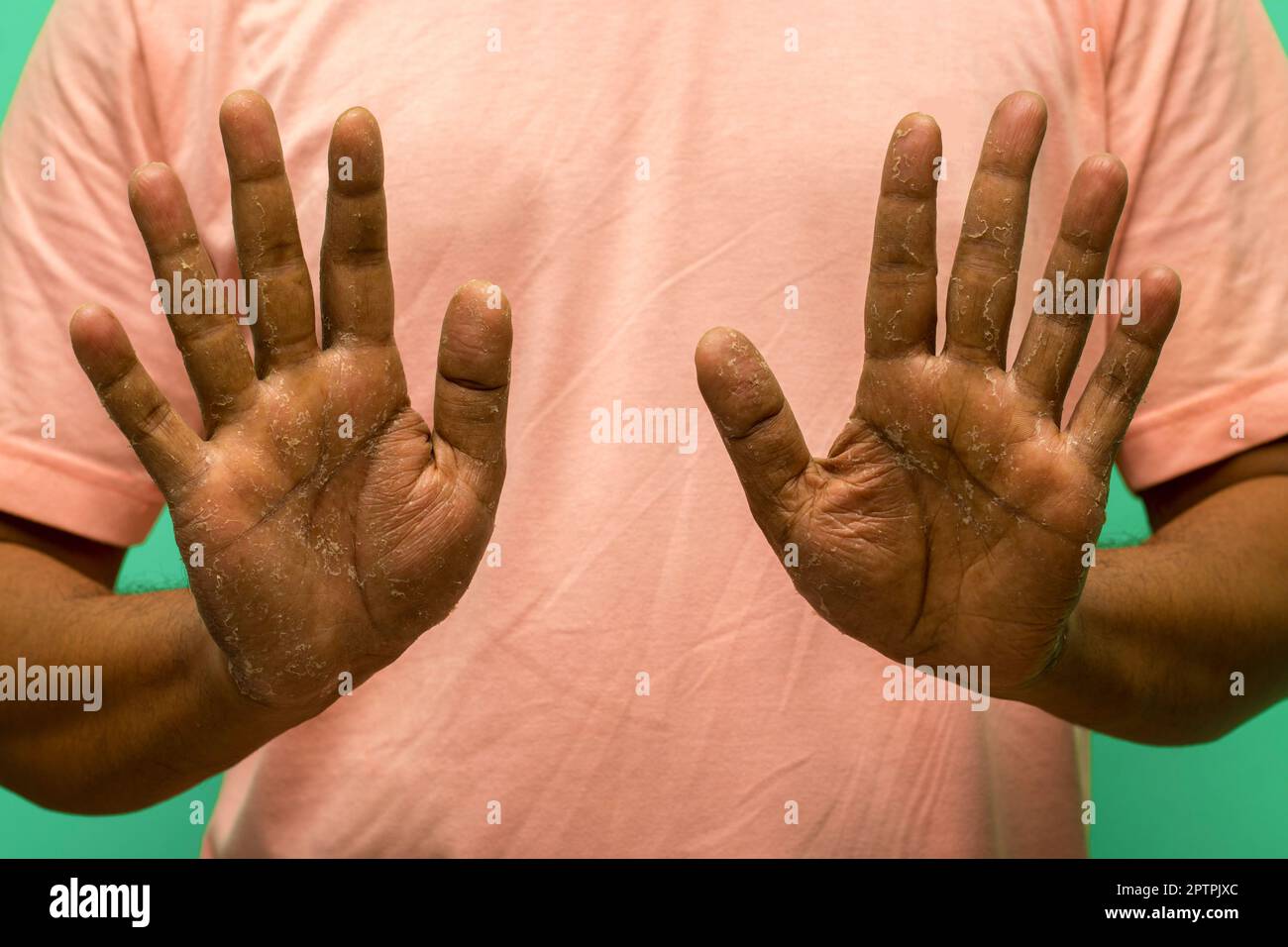 Exfoliative Keratolysis Children