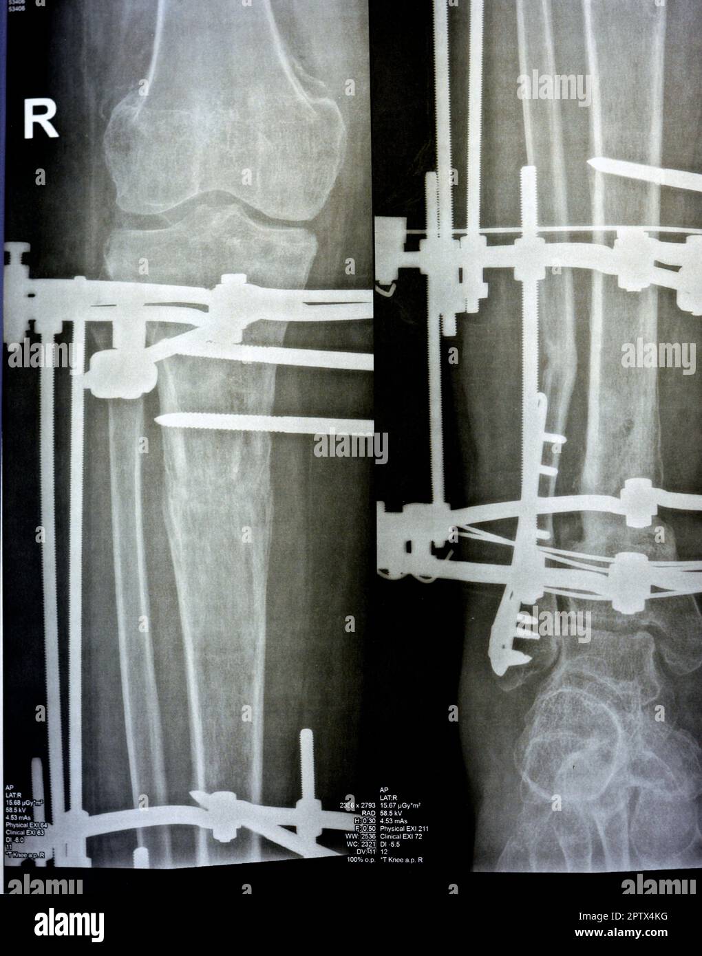 Distal comminuted fracture fibula managed by plate and screws, distal tibia managed by external ring fixator ILIZAROV frame with sclertoic bone resect Stock Photo