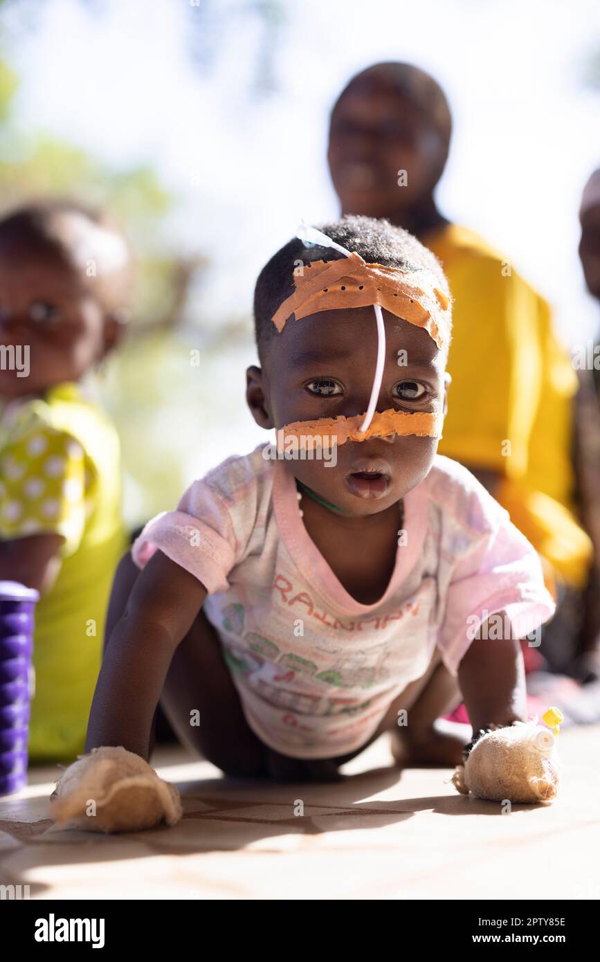 Young child admitted to hospital for malnutrition and malaria in Segou Region, Mali, West Africa. 2022 Mali drought and hunger crisis. Stock Photo