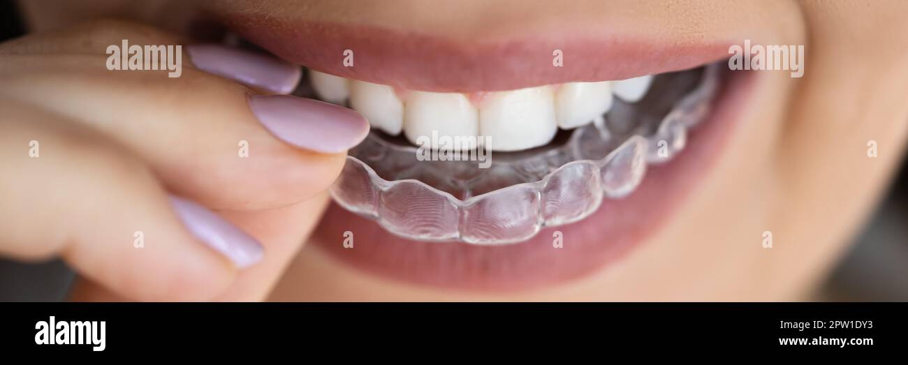 Clear Aligner Dental Night Guard For Teeth Stock Photo Alamy