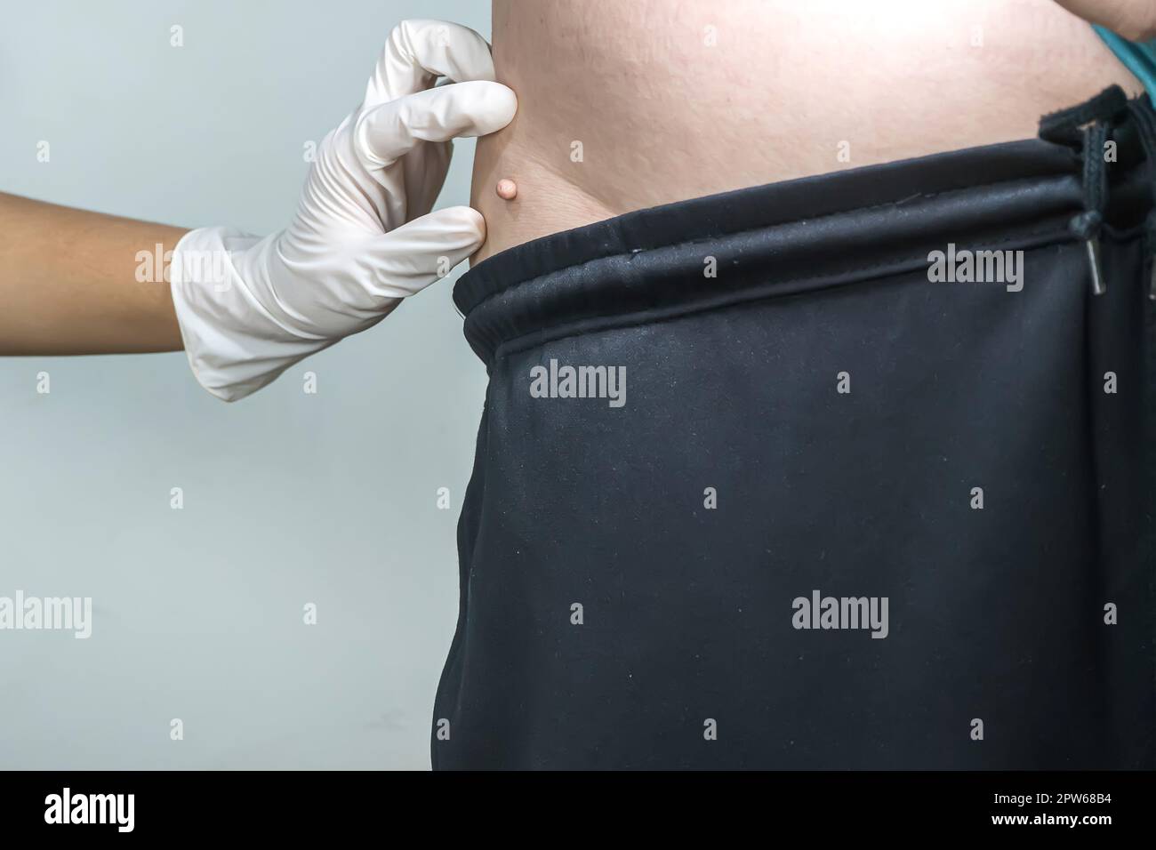 Skin tag or acrochondon or soft fibroma is a safe. It have not effect