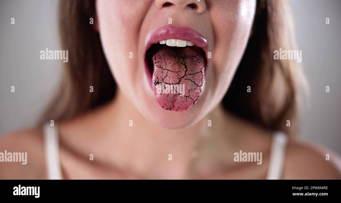 Dry Tongue Pain And Cracks. Oral Candidiasis Stock Photo Alamy