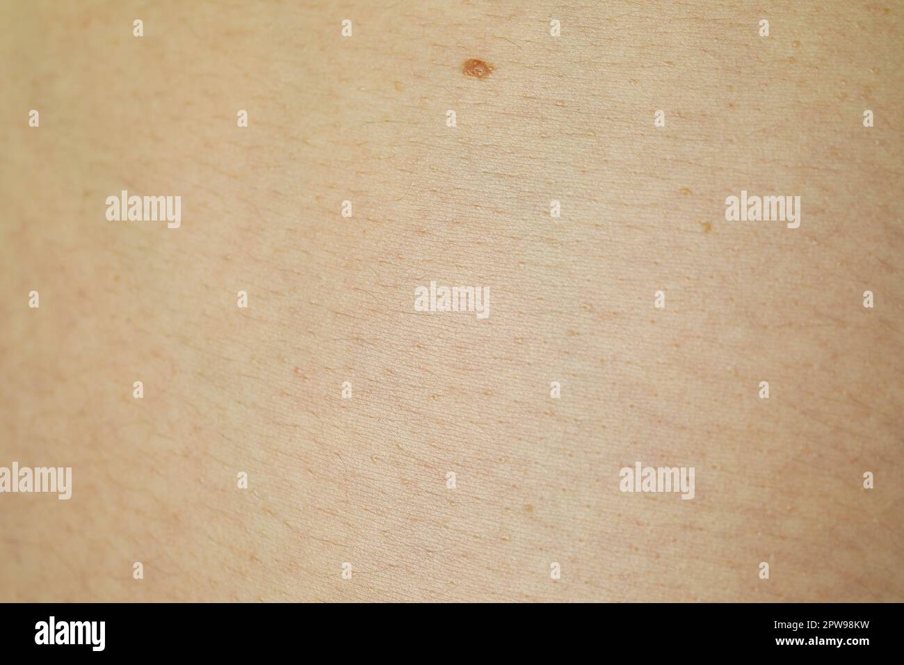 Texture of human skin with birthmark as background, closeup view Stock ...