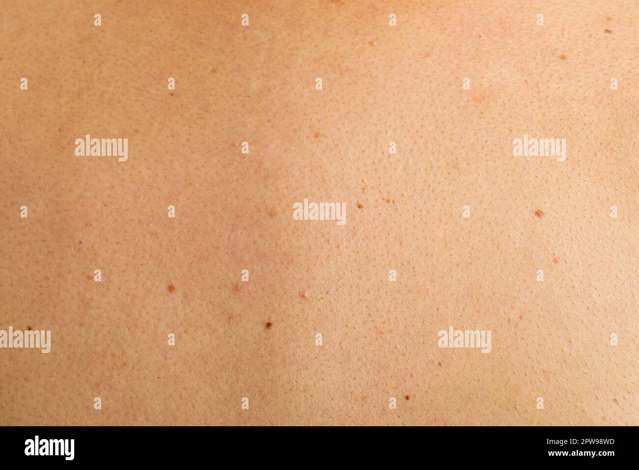 Texture of human skin with birthmarks, closeup view Stock Photo - Alamy