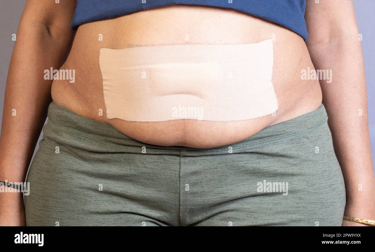 Bandage applied across the midriff of a woman after an operation of the belly button or navel area Stock Photo