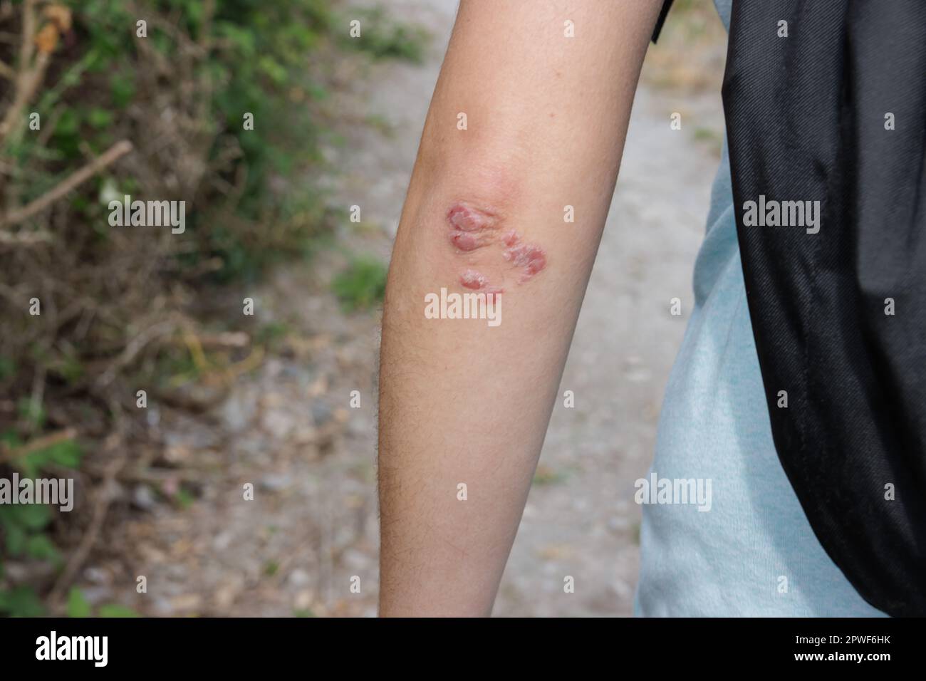 Arm of a woman with a skin rash on her elbows taking a walk in the