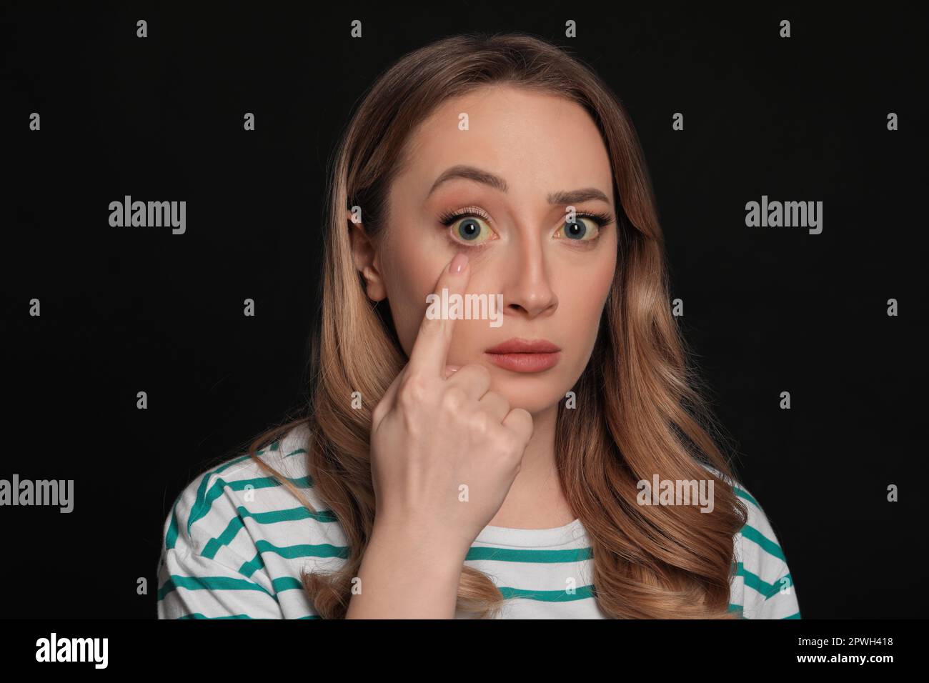 Woman with yellow eyes on black background. Liver problems symptom