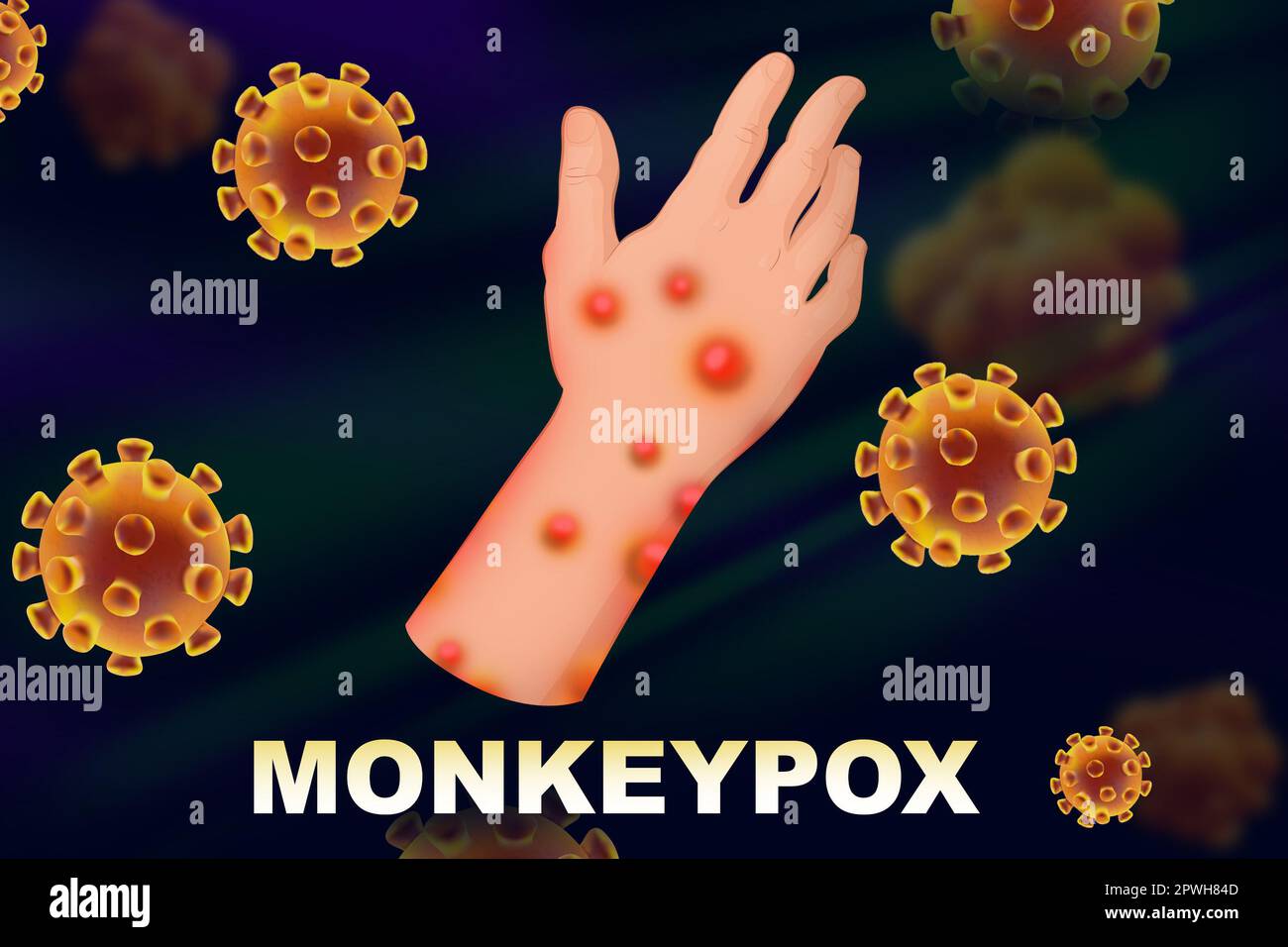 Person diseased by monkeypox virus, illustration. Dangerous disease Stock Photo
