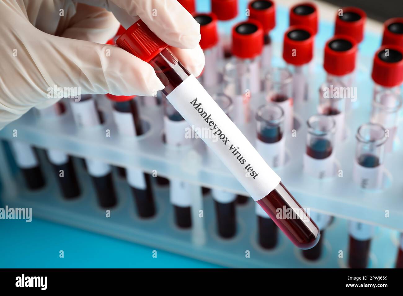 Monkeypox virus test. Laboratory worker holding sample tube with blood ...