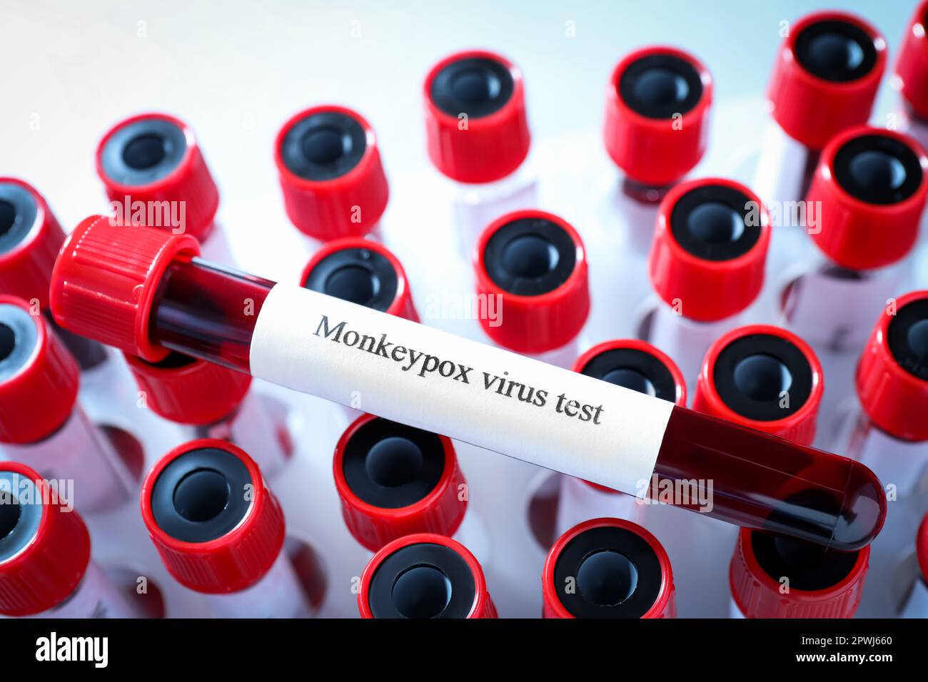 Monkeypox virus test. One sample tube with blood on others, closeup ...