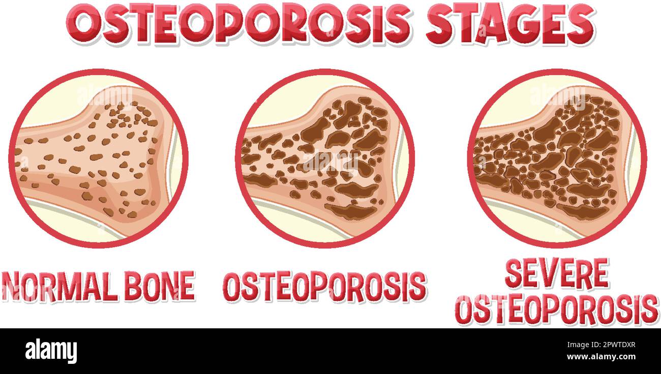 Informative poster of Osteoporosis human bone illustration Stock Vector