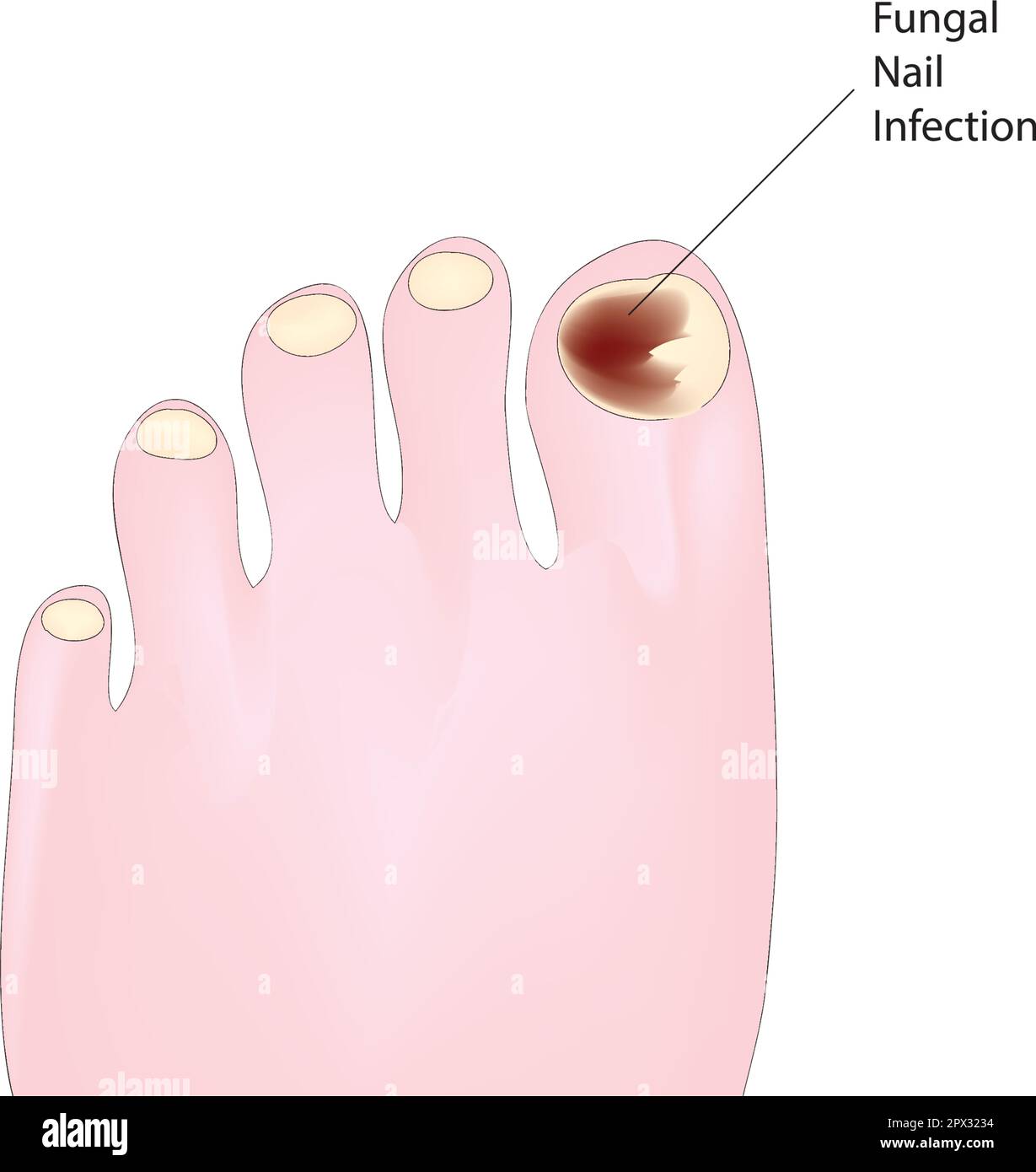 fungal nail infection Stock Vector