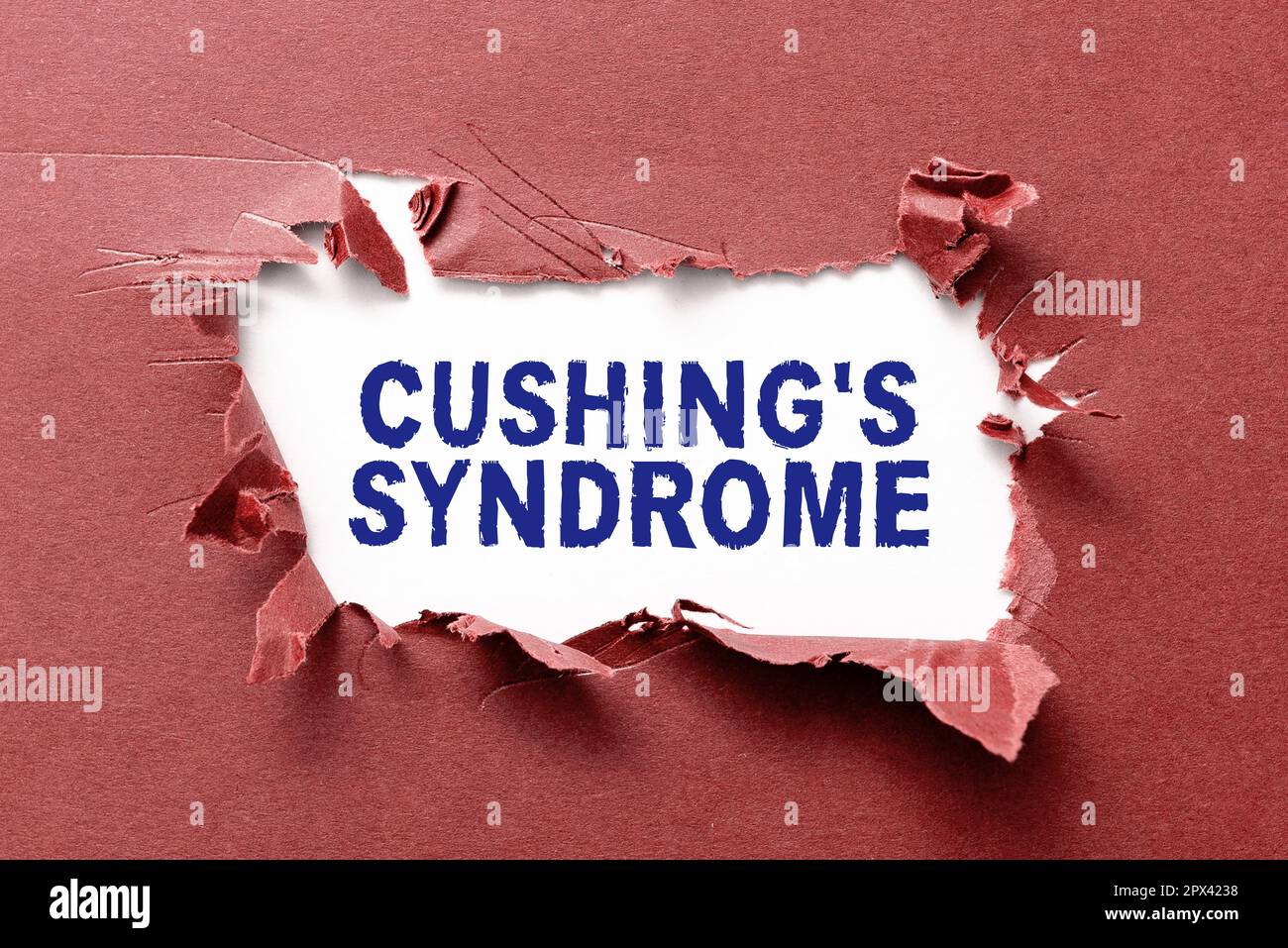 Inspiration showing sign Cushing's Syndrome, Conceptual photo a disorder caused by corticosteroid hormone overproduction Stock Photo