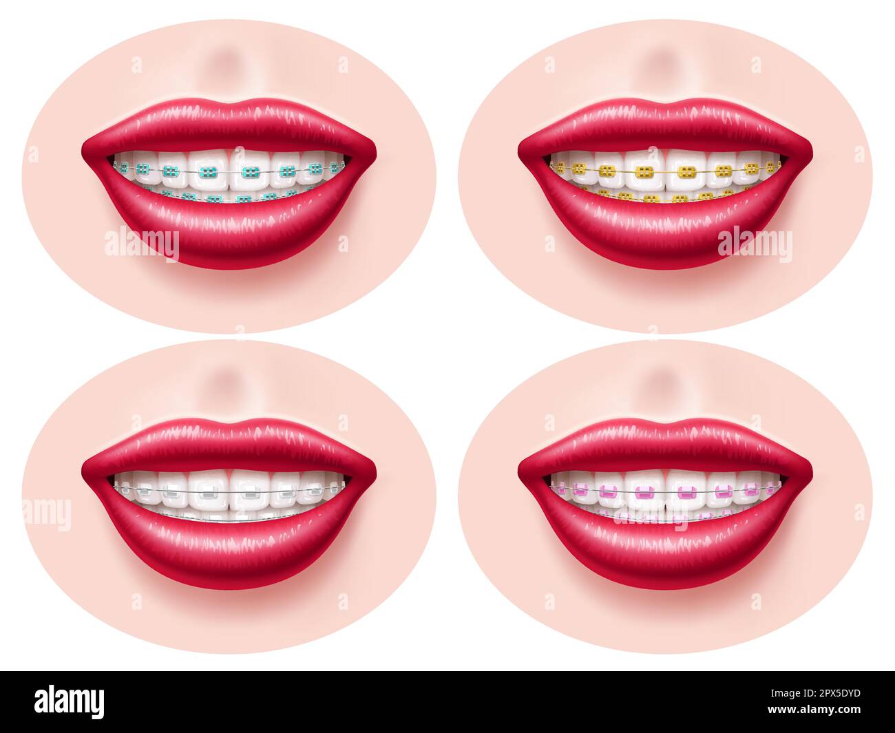 Realistic teeth dental braces. Smiling lips, orthodontic bite