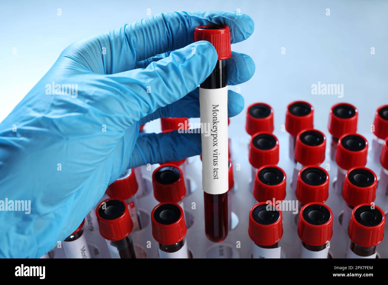 Monkeypox virus test. Laboratory worker putting sample tube with blood ...