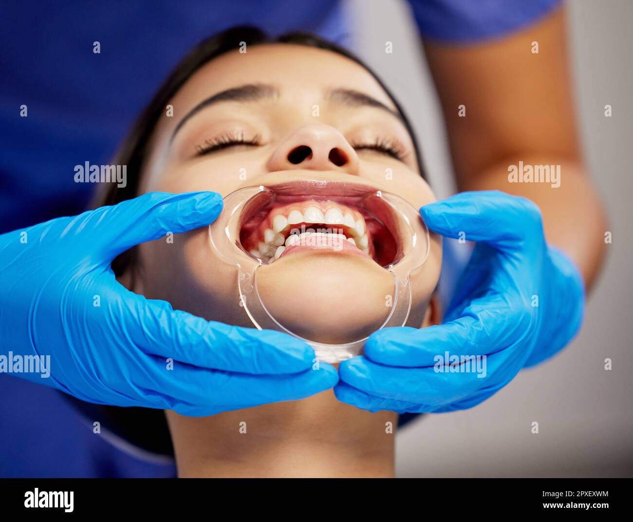 Using a cheek retractor can make a real difference. a young woman