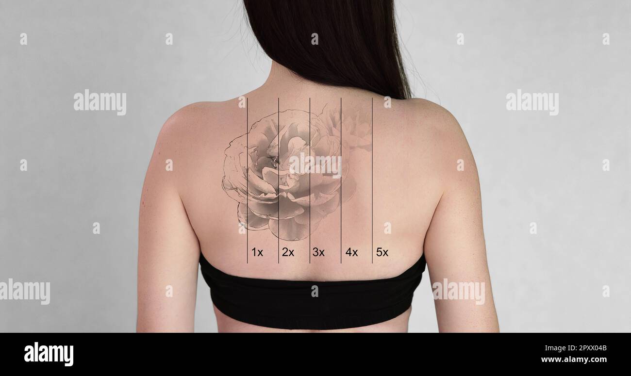 Tattoo remove me hi res stock photography and images Page 3 Alamy