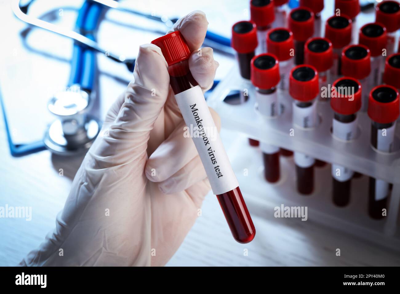 Monkeypox virus test. Laboratory worker holding sample tube with blood ...