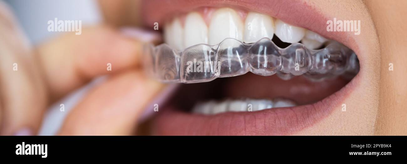 Clear Aligner Dental Night Guard Stock Photo Alamy