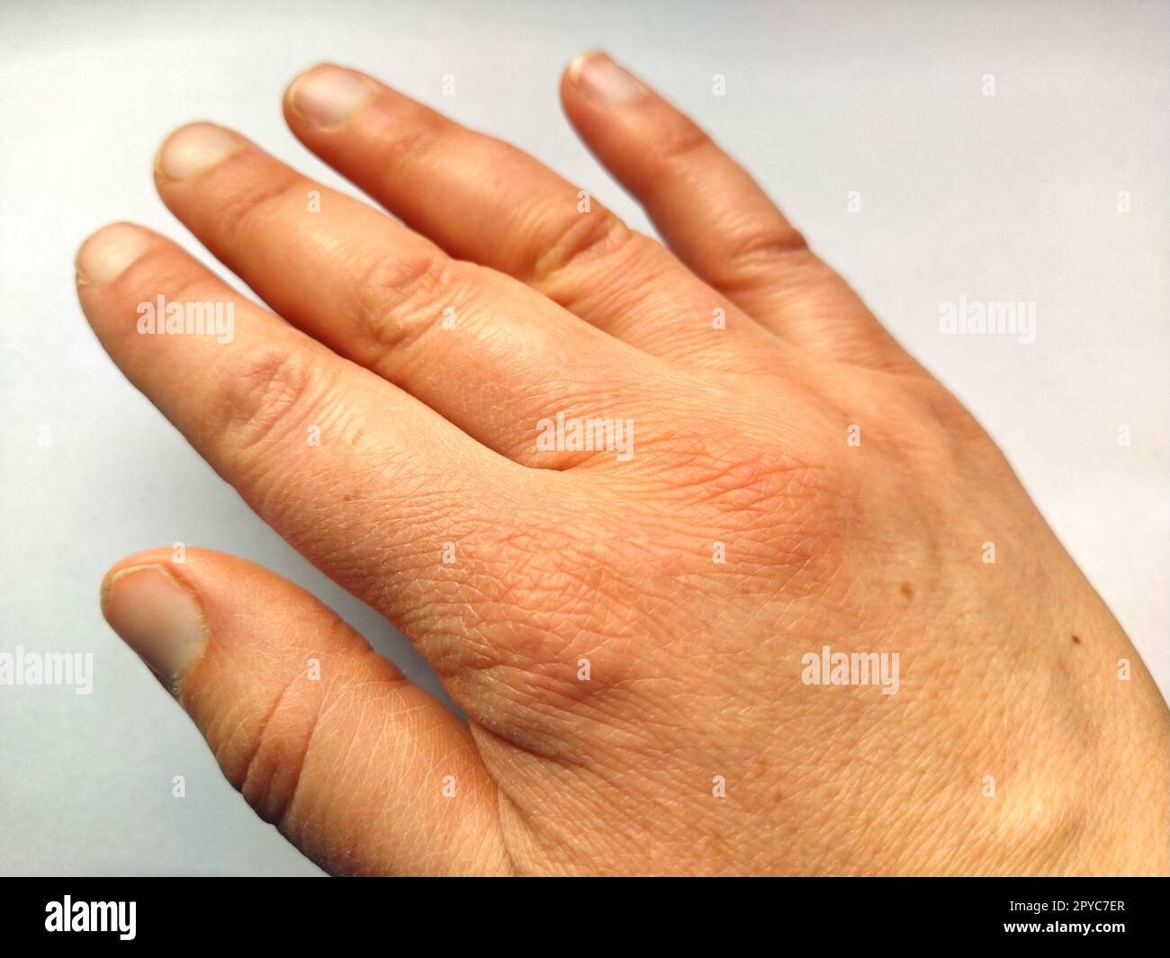 Female hand with dry atopic skin and sore joints. White background. Close-up of the skin. Pain in the joints of the hand and hand. Degenerative diseases or injuries. Arthralgia, arthritis or gout Stock Photo