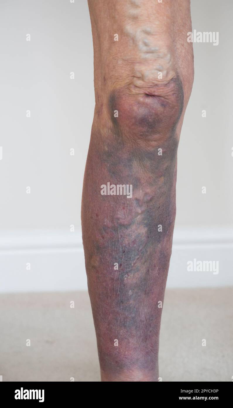 Severe bruising leg hires stock photography and images Alamy