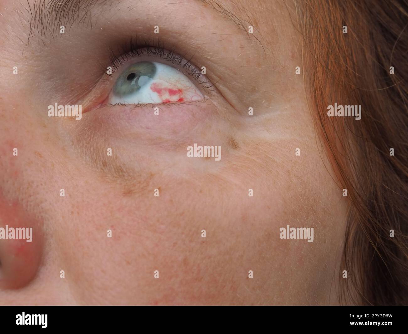 Subconjunctival hemorrhage or subconjunctival bleeding, hyposhagmus