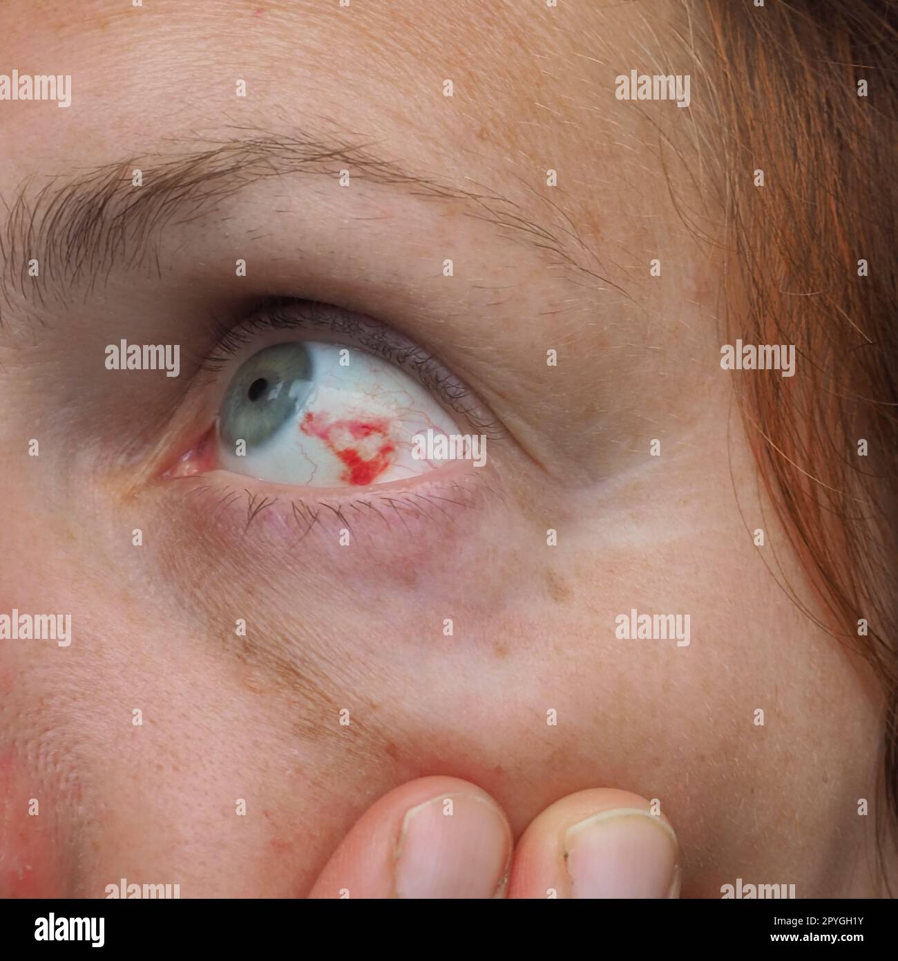 Subconjunctival hemorrhage newborn