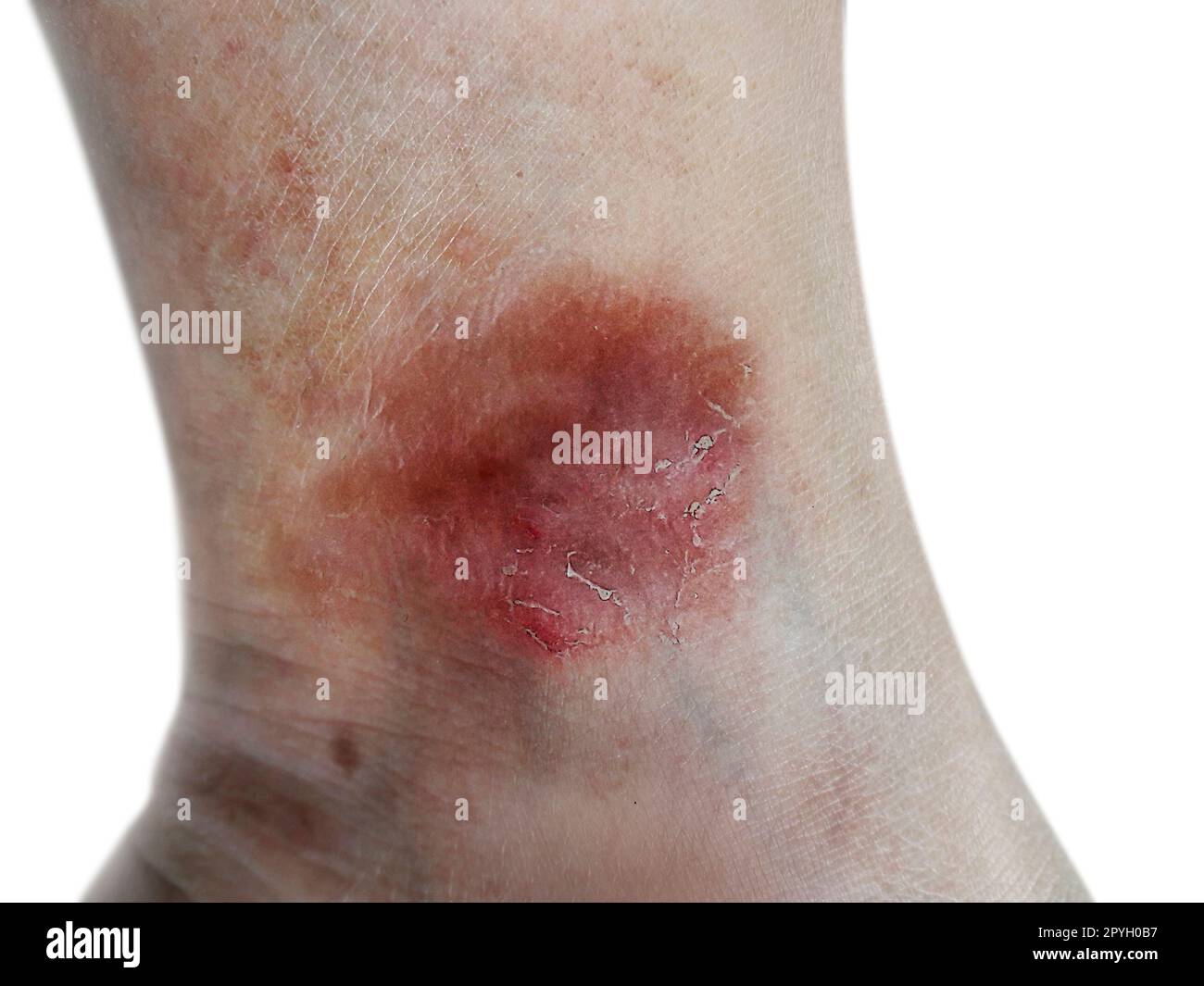 Close up dermatitis on skin, ill allergic rash dermatitis eczema skin of patient , atopic dermatitis symptom skin detail texture , Fungus of skin ,The concept dermatology, treatment fungal and fungal Stock Photo