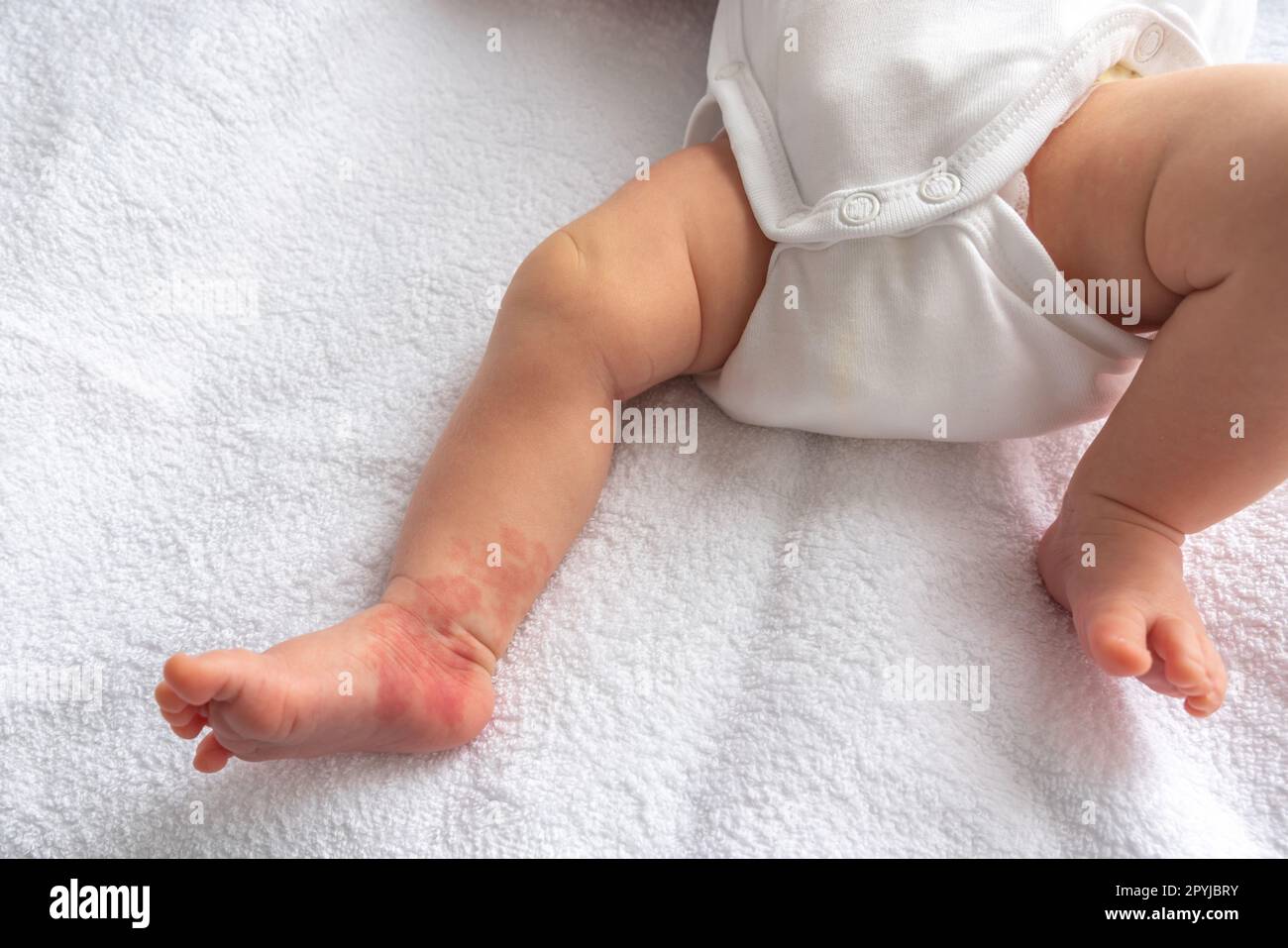 Hemangioma red birthmark on the leg of newborn baby Stock Photo