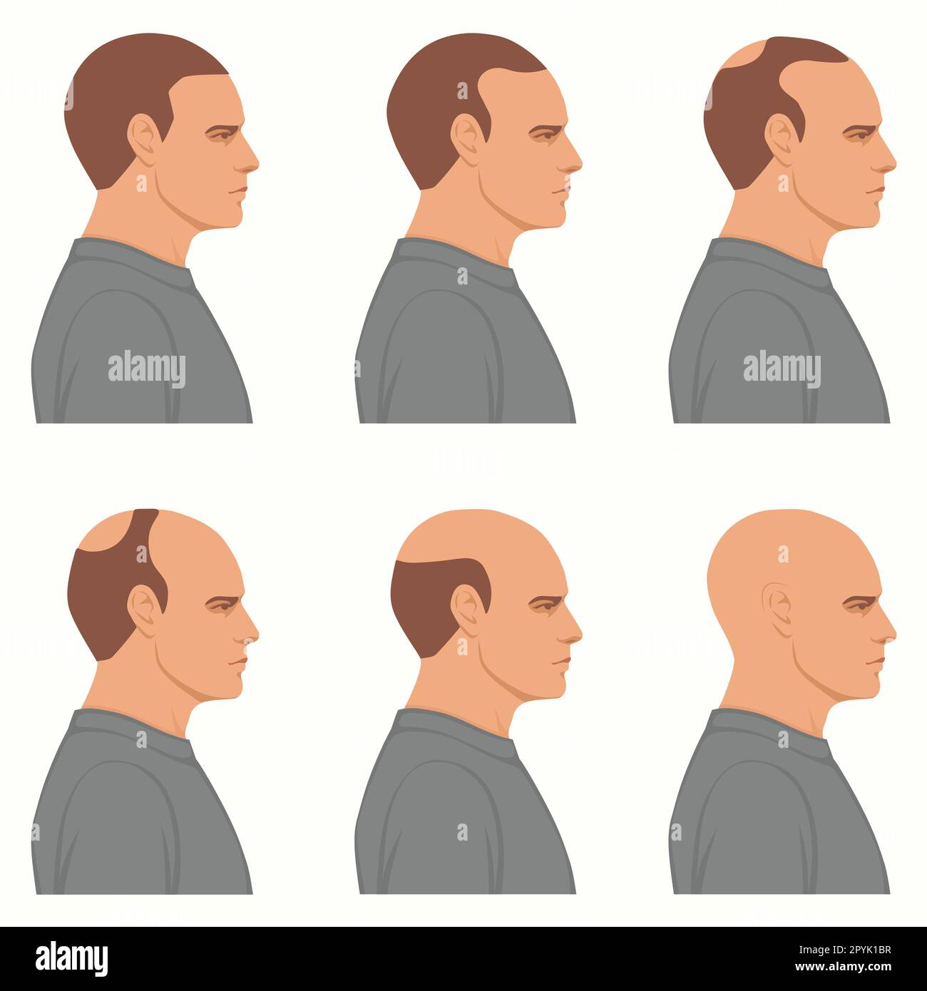 Information Chart Showing Stages Of Hair Loss For Men Bolding Head 