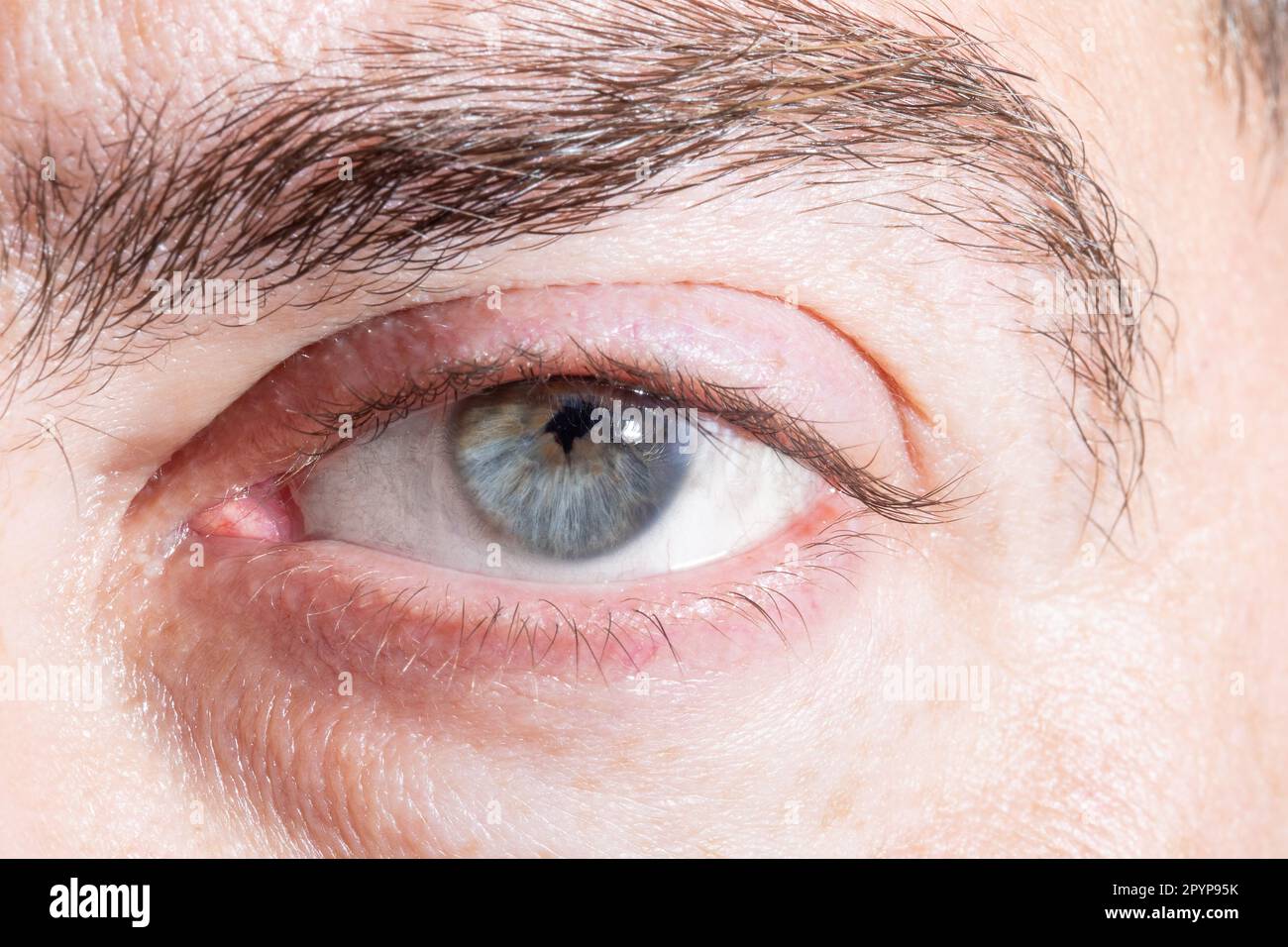 Macro of a male human eye with a jagged and irregular pupil after lens surgery due to uveitis. Iritis phenomenon came iridocyclitis Stock Photo