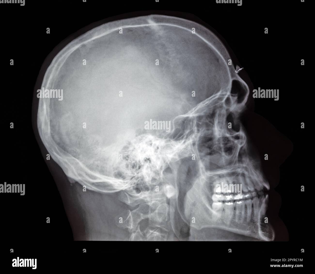 Lateral skull xray with a foriegn body Stock Photo Alamy