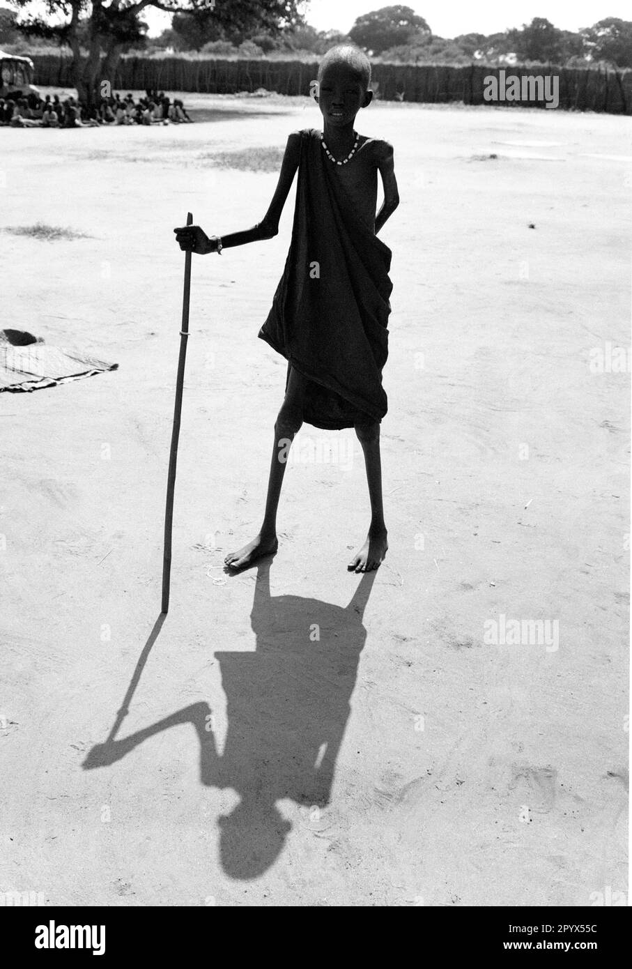 SDN , SUDAN : A malnourished boy in a feeding centre in Ayod in the south of Sudan 10.08.1993 Stock Photo