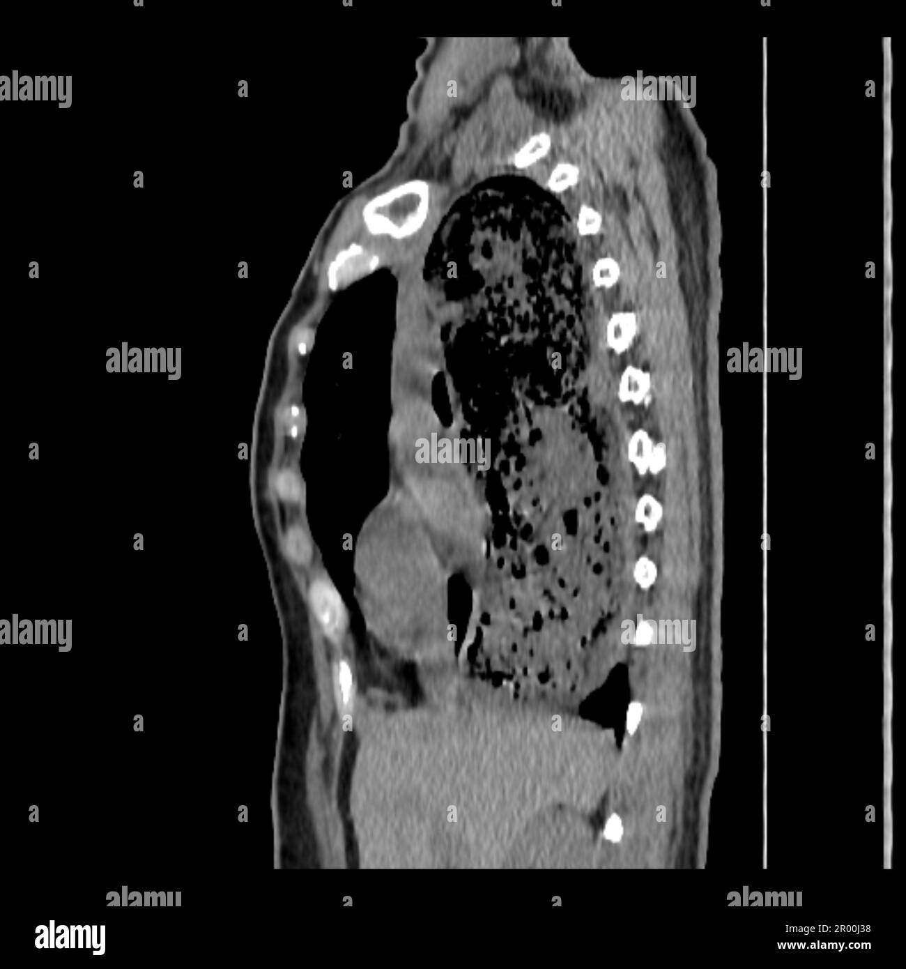 Achalasia of the oesophagus, CT scan Stock Photo