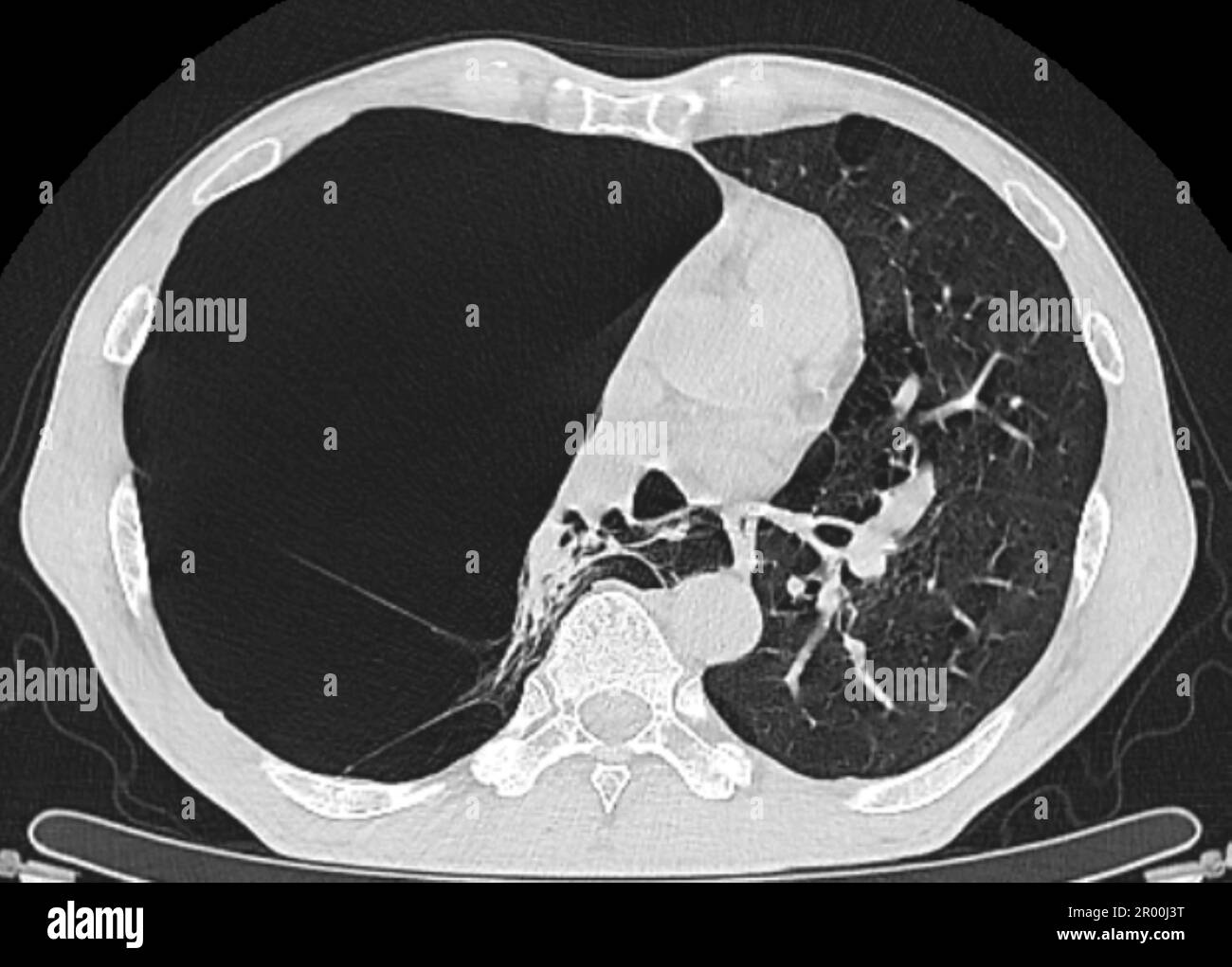 Pulmonary giant bulla, CT scan Stock Photo