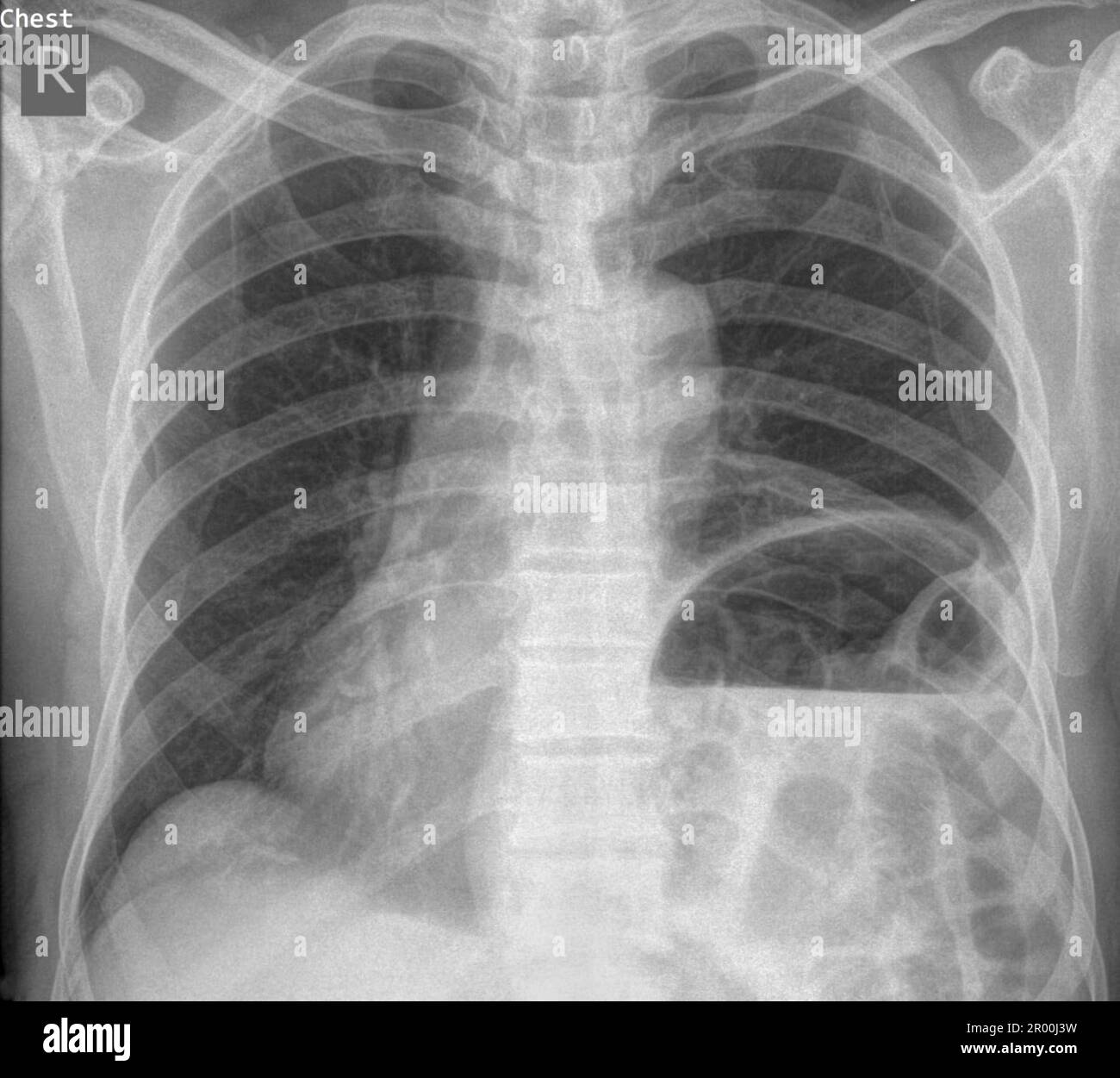 Hiatus hernia, X-ray Stock Photo