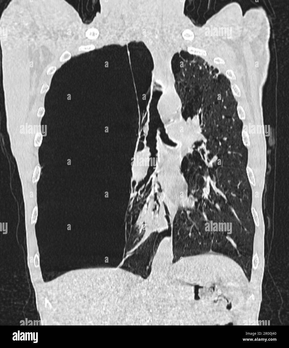 Pulmonary giant bulla, CT scan Stock Photo