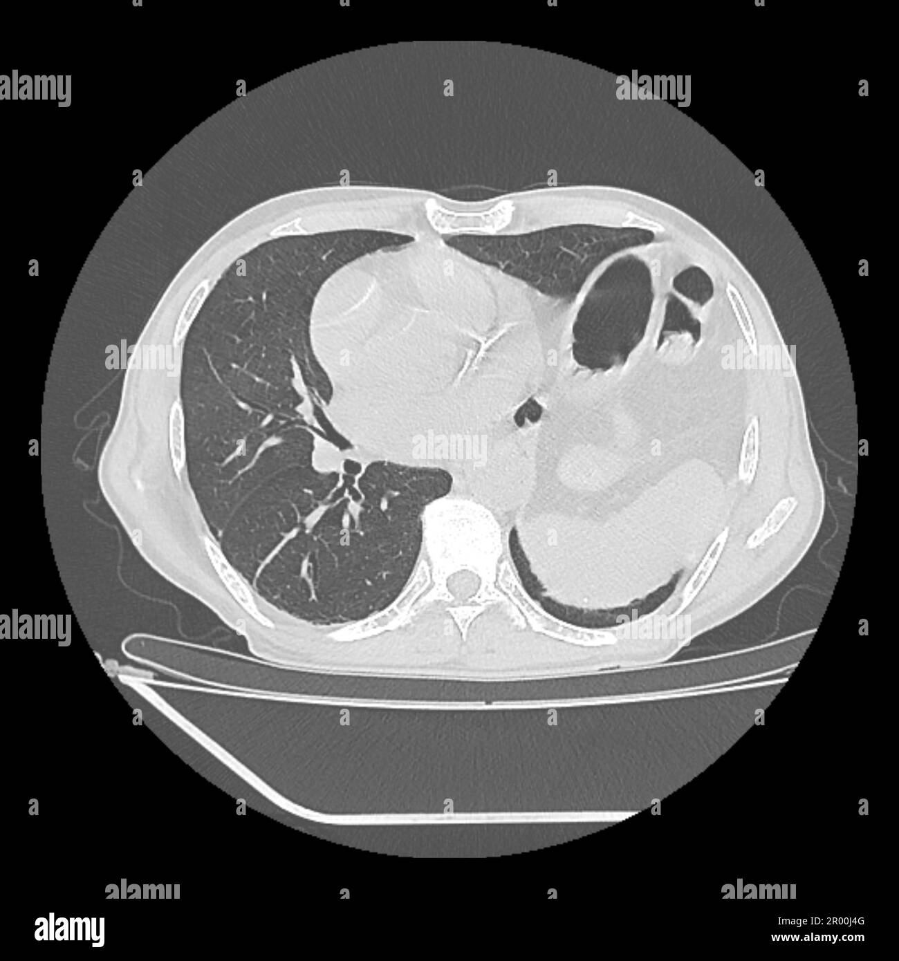 Hiatus hernia, CT scan Stock Photo - Alamy