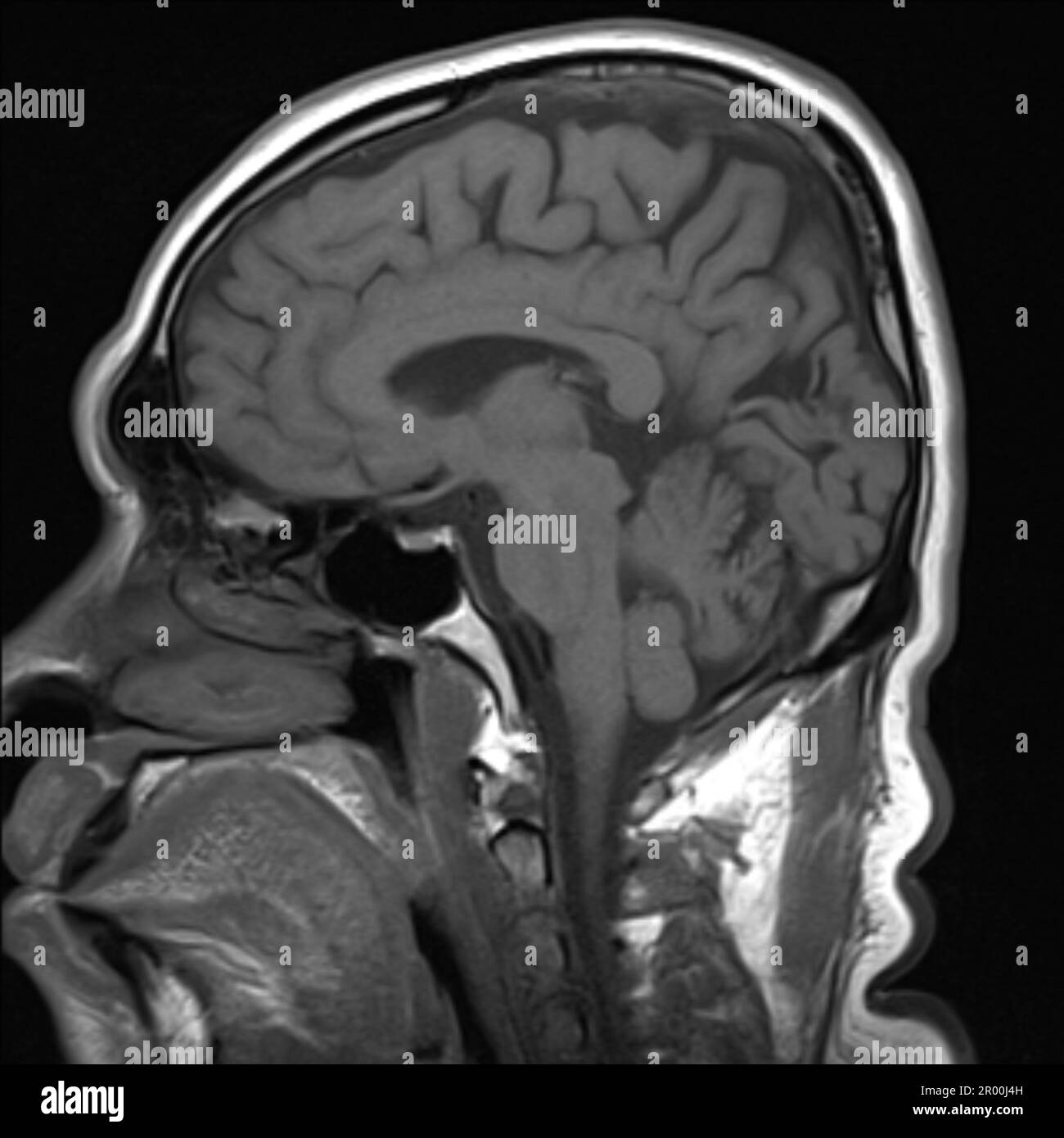 Healthy human brain, MRI scan Stock Photo - Alamy