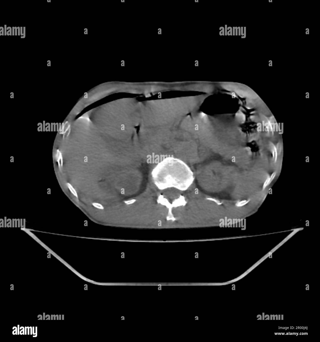 Pneumoperitoneum, CT scan Stock Photo