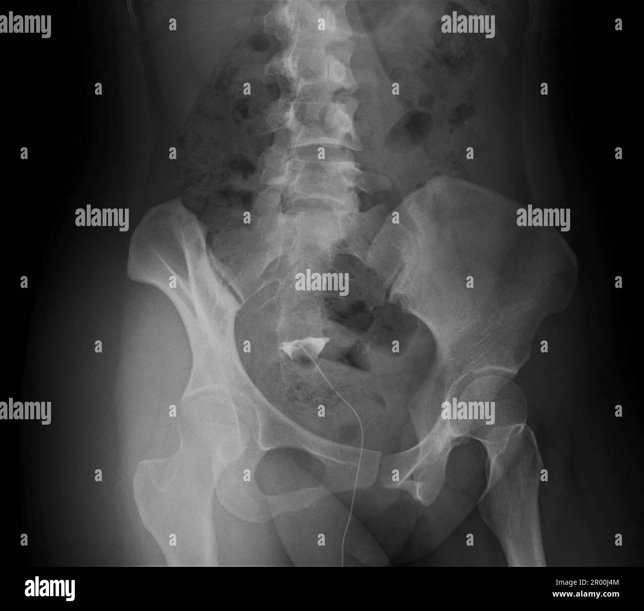 Obstructed fallopian tubes, Xray Stock Photo Alamy