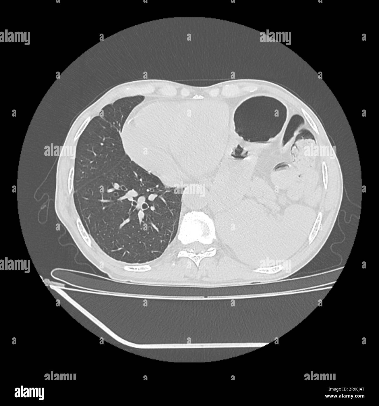 Hiatus hernia, CT scan Stock Photo