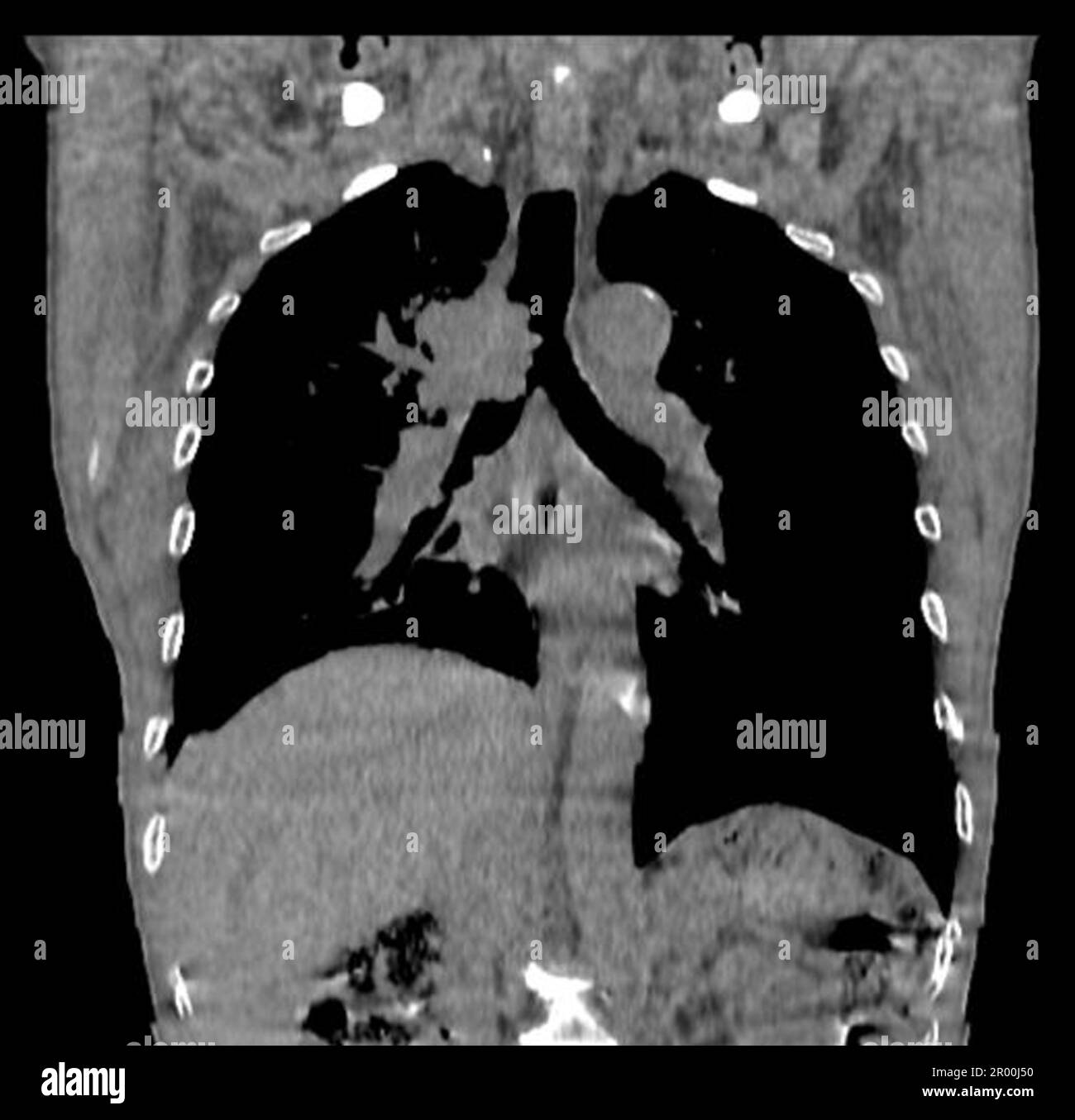 Lung cancer, CT scan Stock Photo