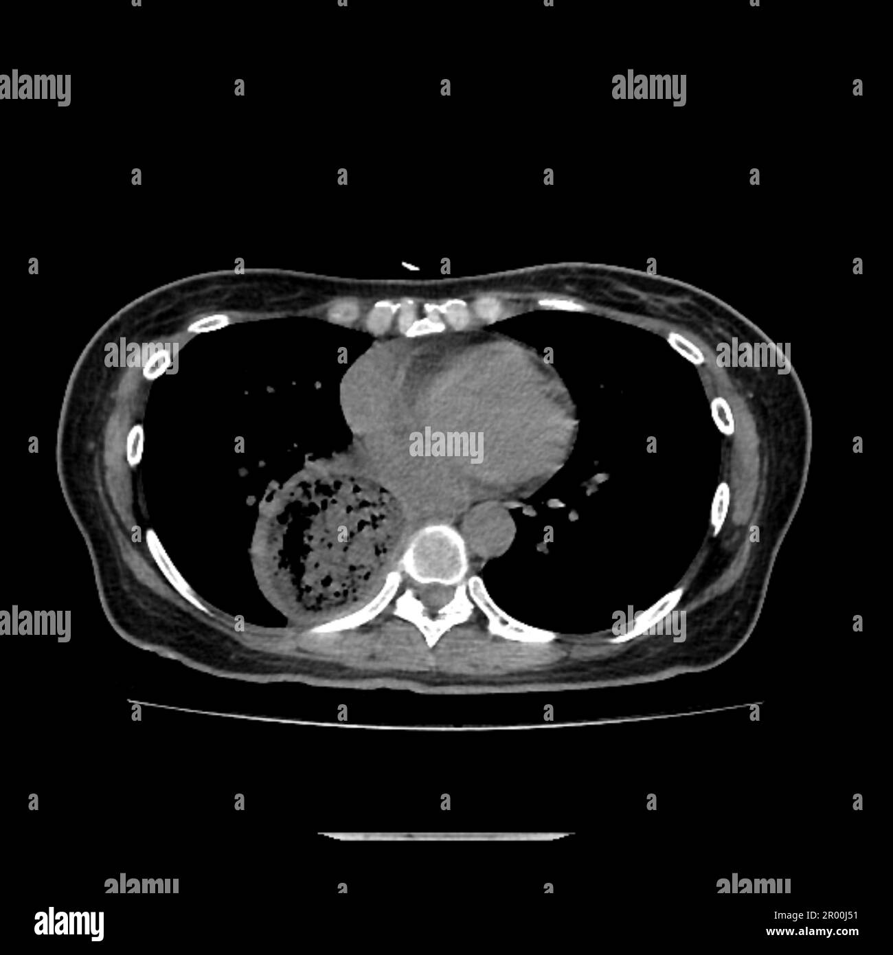 Achalasia of the oesophagus, CT scan Stock Photo