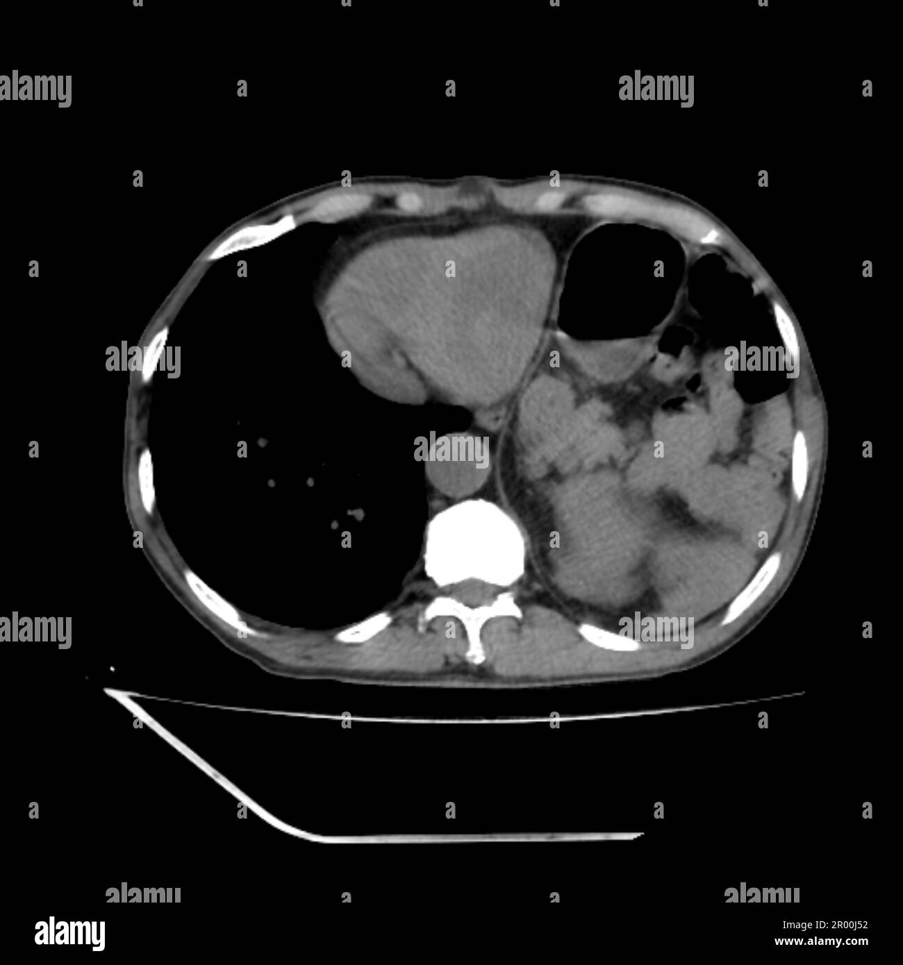 Hiatus hernia, CT scan Stock Photo - Alamy